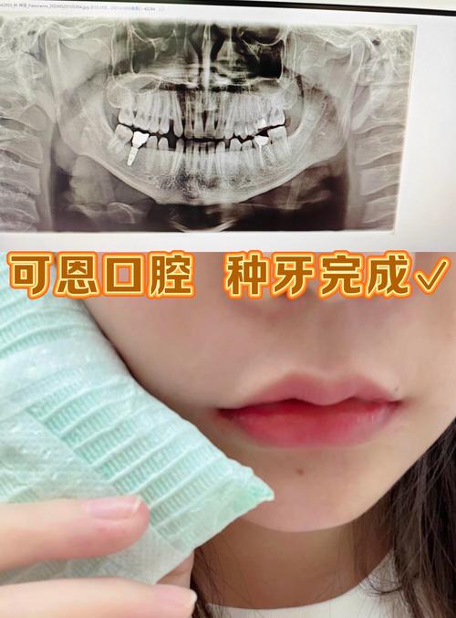 福州植牙那家好-图3