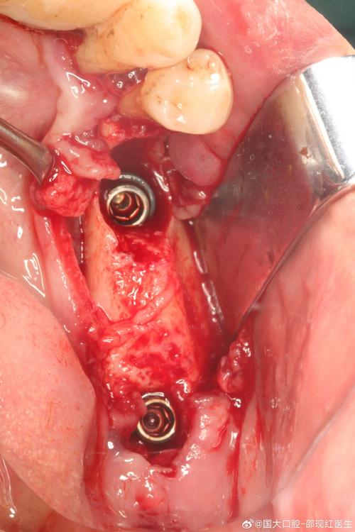 口腔骨移植植牙-图2