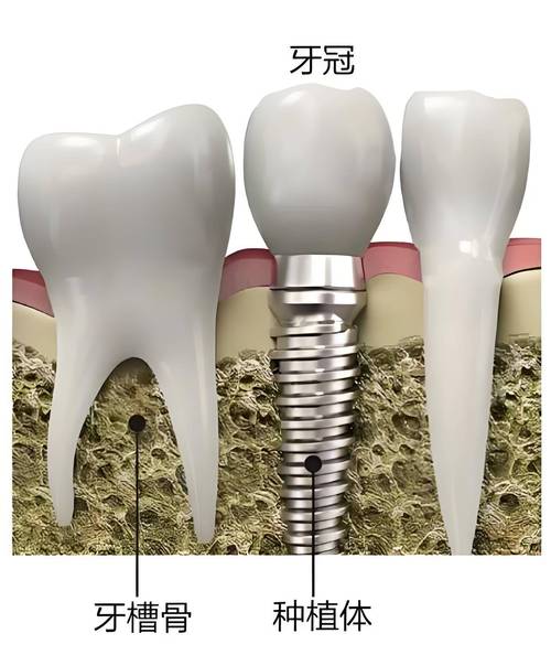 植牙会影响邻近牙齿的健康吗？-图1