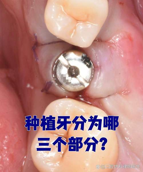 植牙会影响邻近牙齿的健康吗？-图2