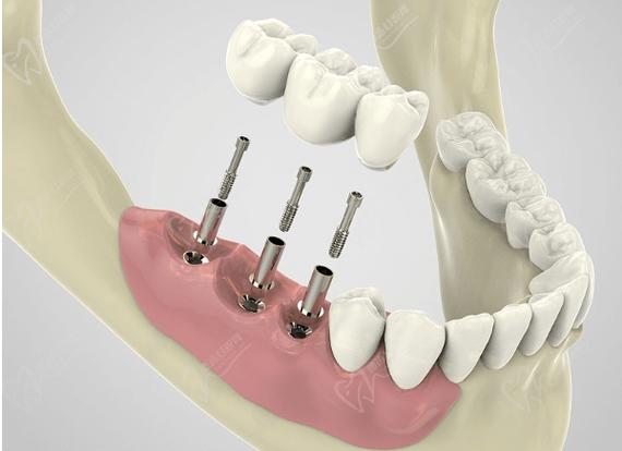 bego植牙图-图1 bego植牙图-图1
