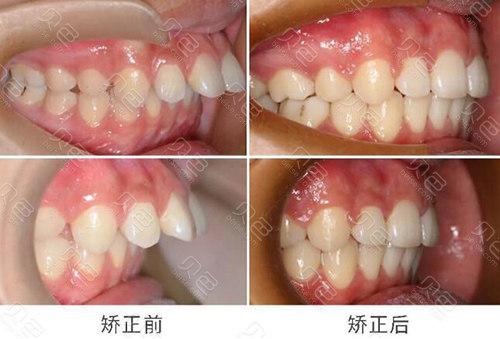 深覆合正畸前后对比-图3