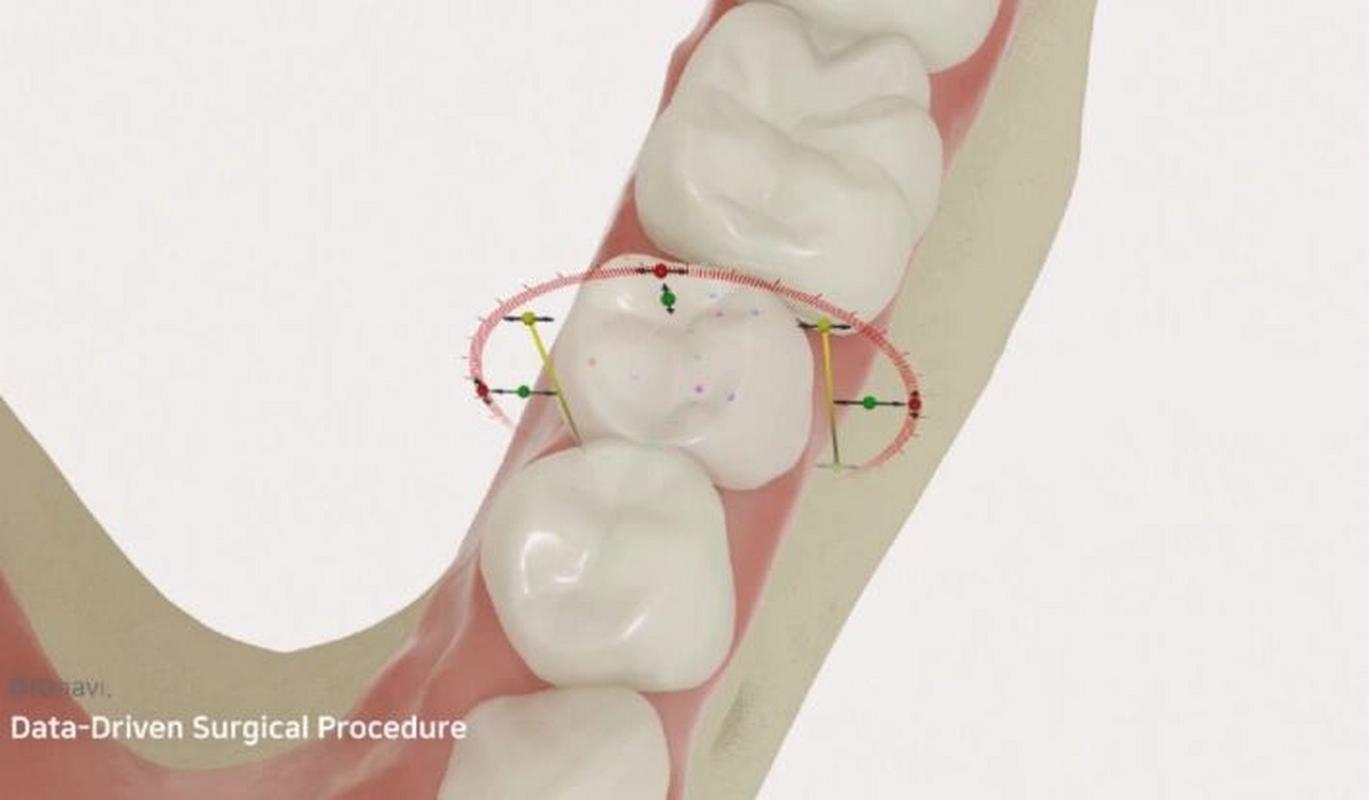 dio植牙规格-图1