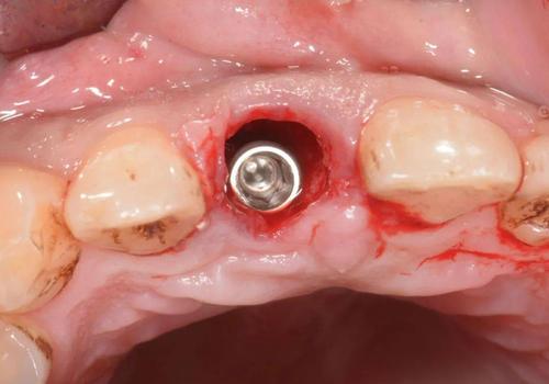 即刻植牙 前牙-图1