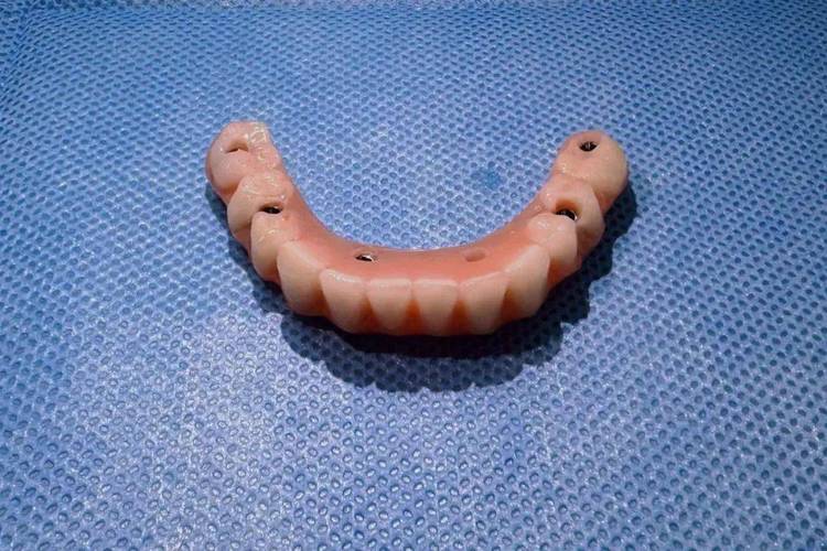 植牙后临时牙套-图1