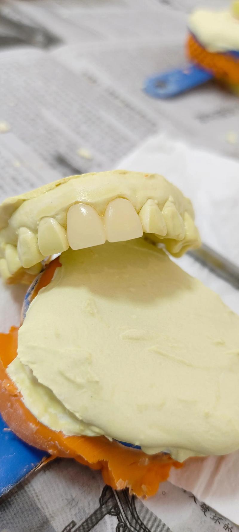 植牙后临时牙套-图3