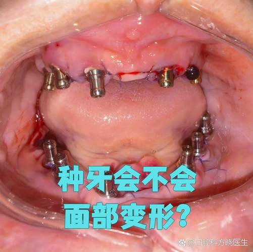 没有牙可以植牙-图2