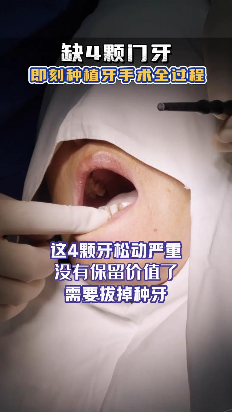 缺牙太久没处理,现在植牙还来得及吗?-图2 缺牙太久没处理,现在植牙还来得及吗?-图2