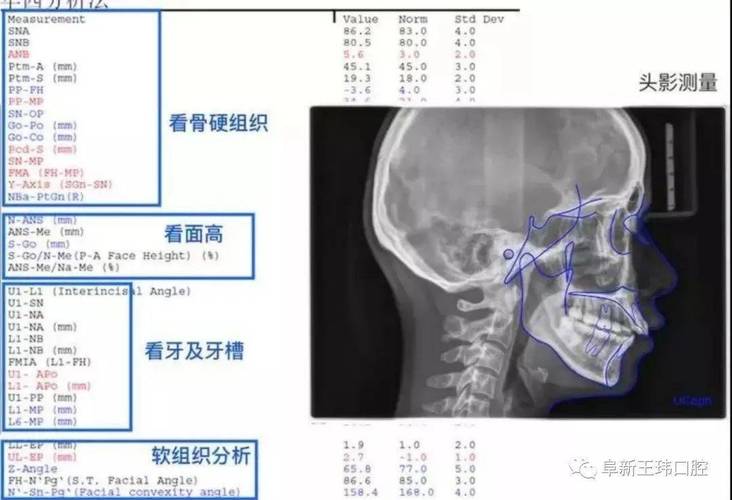 口腔正畸头颅侧位片-图1 口腔正畸头颅侧位片-图1