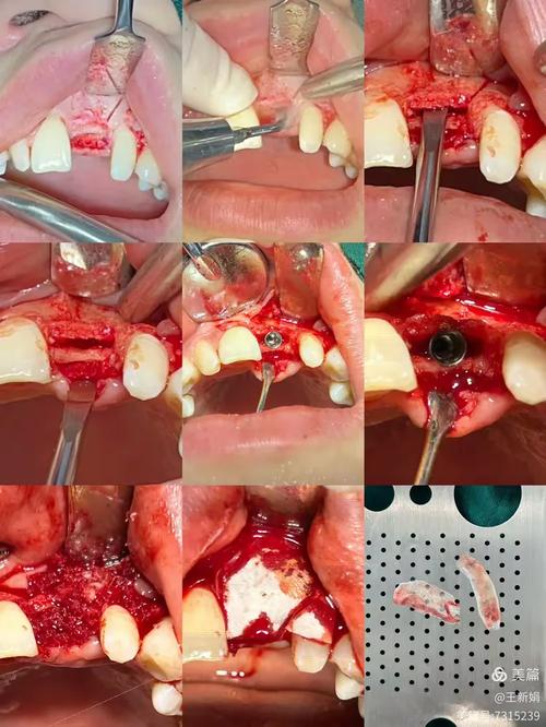 牙周手术植骨效果如何？恢复期需注意什么？多久能恢复正常？-图2
