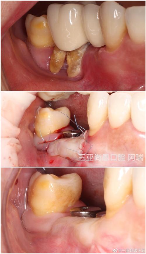 牙周手术植骨效果如何？恢复期需注意什么？多久能恢复正常？-图3