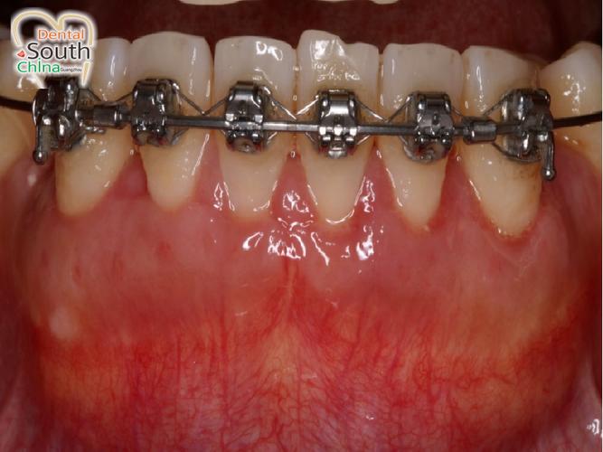 正畸 骨皮质切开术-图3