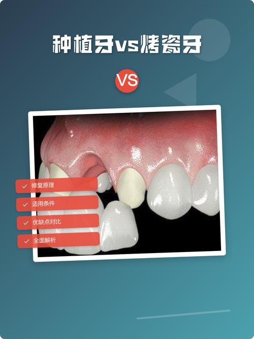 植牙和烤瓷牙,哪种更适合你的牙齿修复?-图1 植牙和烤瓷牙,哪种更适合你的牙齿修复?-图1