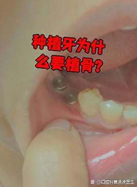 牙槽植骨痛-图1