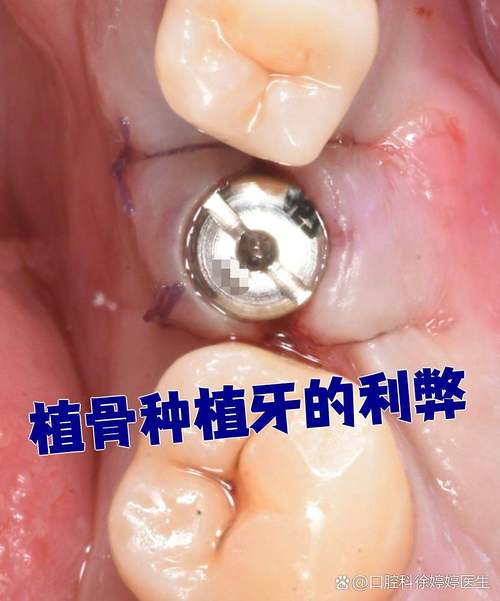 自碎牙植骨效果如何？优势究竟在哪？-图2