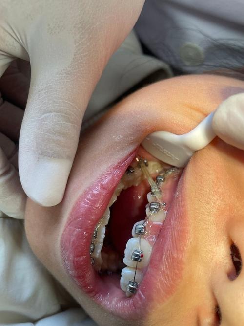 深圳儿童医院 正畸-图3