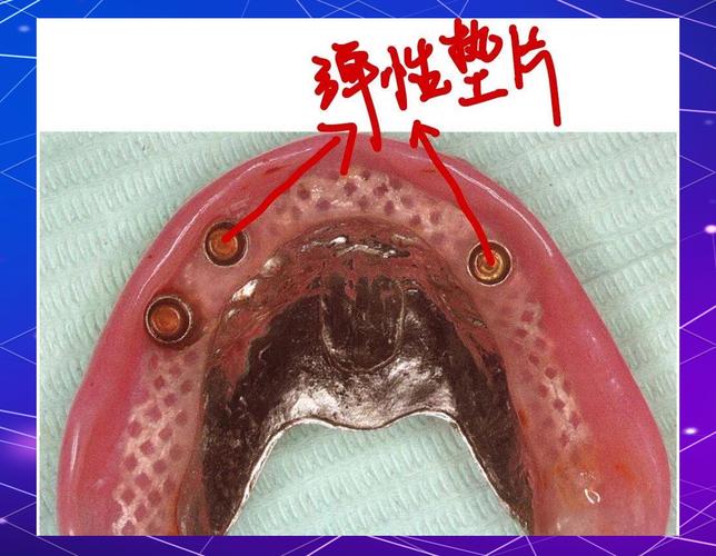 杠卡式植牙-图1