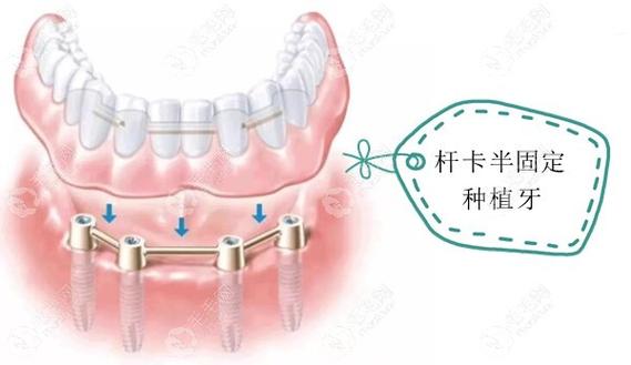 杠卡式植牙-图2