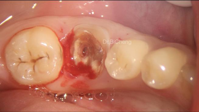 植牙自体股-图2