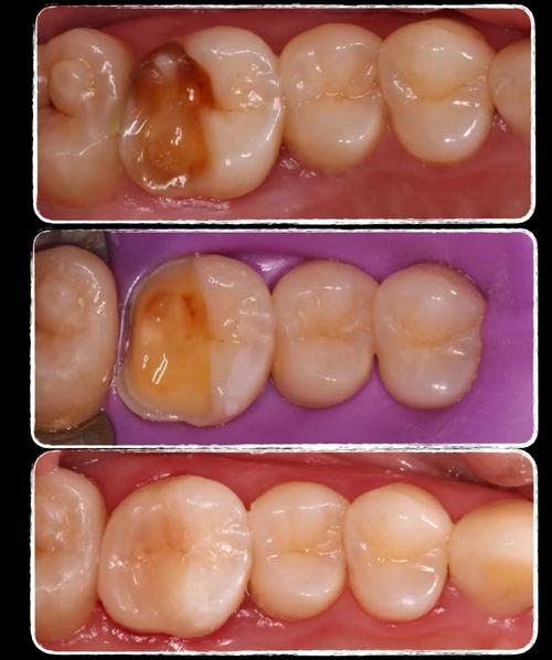 嵌体和植牙有何区别？如何根据牙齿情况选择？-图1