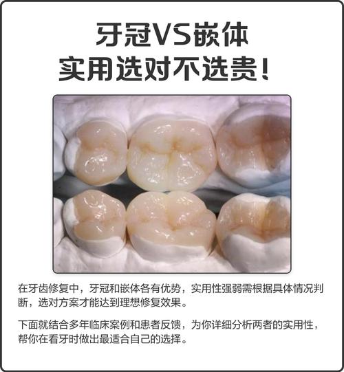 嵌体和植牙有何区别？如何根据牙齿情况选择？-图2