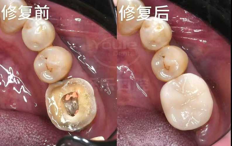 嵌体和植牙有何区别？如何根据牙齿情况选择？-图3
