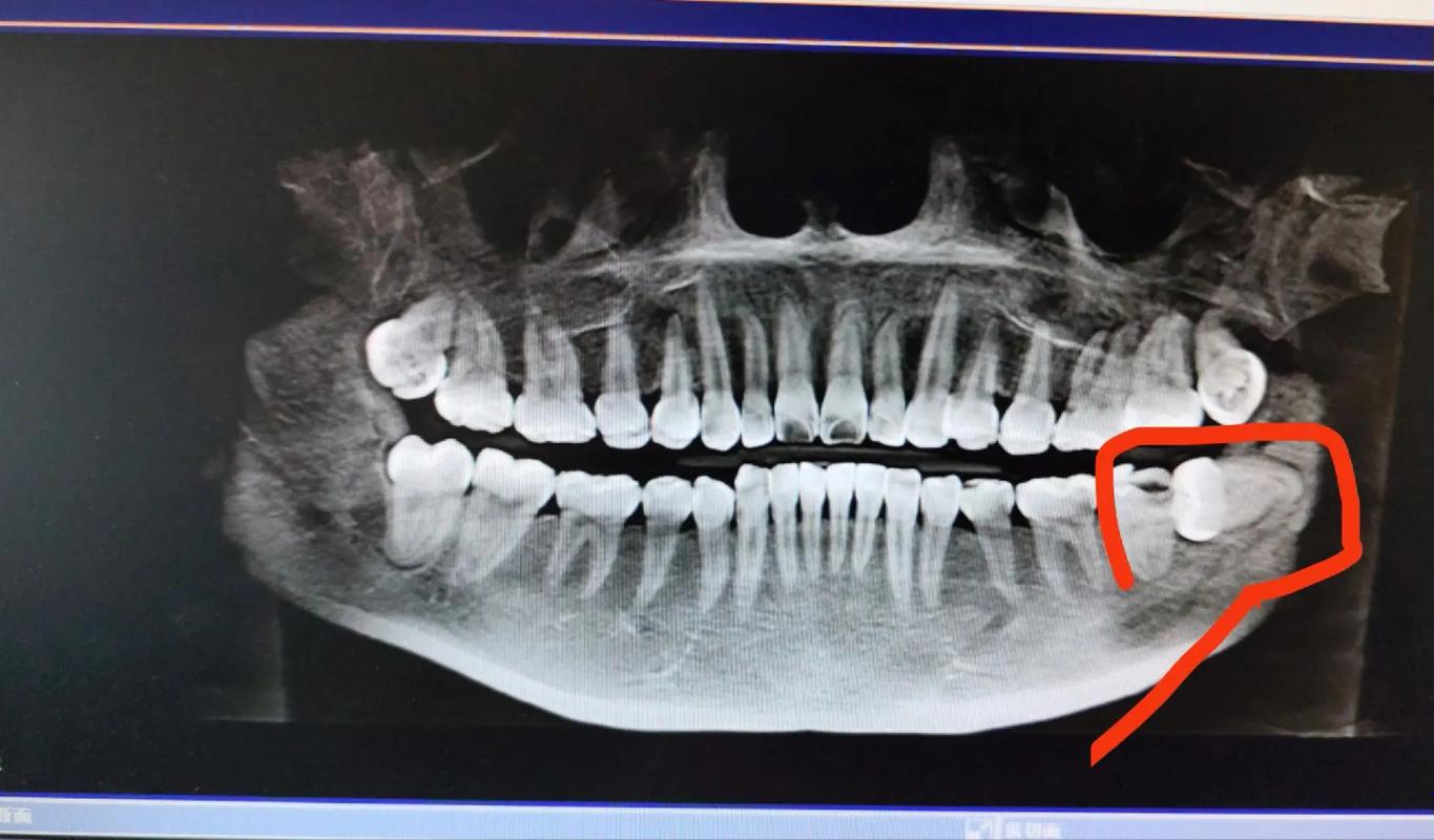 正畸智齿还没长出来-图1