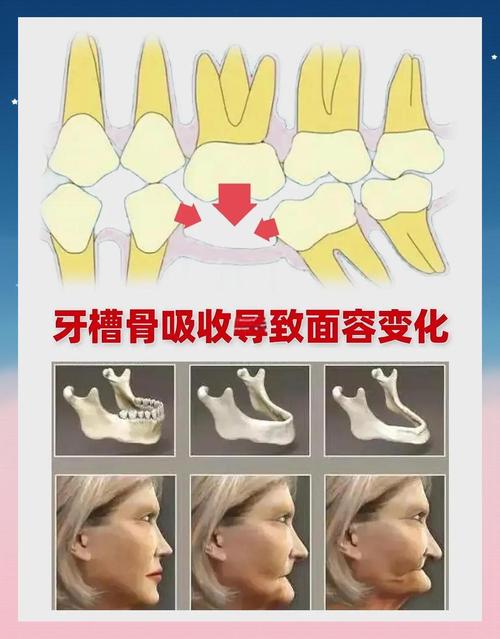 正畸智齿一定要拔吗-图2 正畸智齿一定要拔吗-图2