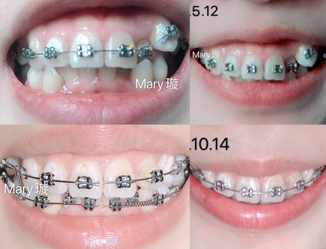 正畸牙缝收得慢，是什么原因导致的？-图1