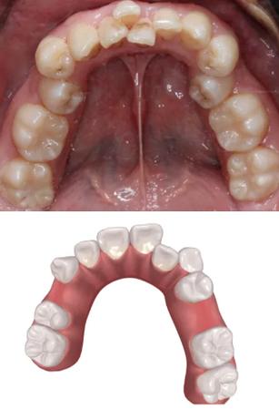 牙齿正畸是否都得拔智齿？拔与不拔有何影响？-图2