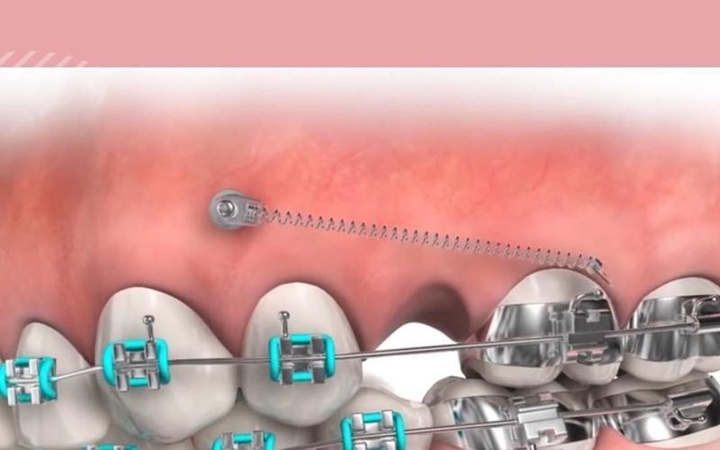 牙齿正畸打骨钉图片,过程疼不疼?效果怎么样?-图2 牙齿正畸打骨钉图片,过程疼不疼?效果怎么样?-图2