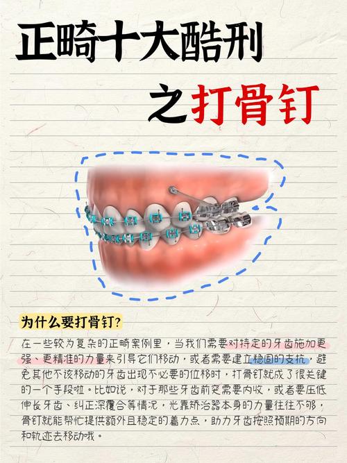 牙齿正畸打骨钉图片,过程疼不疼?效果怎么样?-图3 牙齿正畸打骨钉图片,过程疼不疼?效果怎么样?-图3