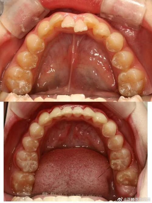 不拔牙正畸会更龅牙-图2