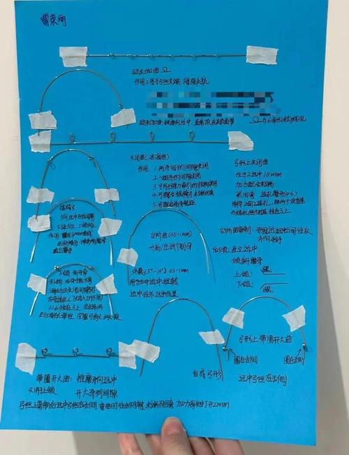 正畸弓丝型号顺序如何选择?不同阶段用哪种才合适?-图2 正畸弓丝型号顺序如何选择?不同阶段用哪种才合适?-图2