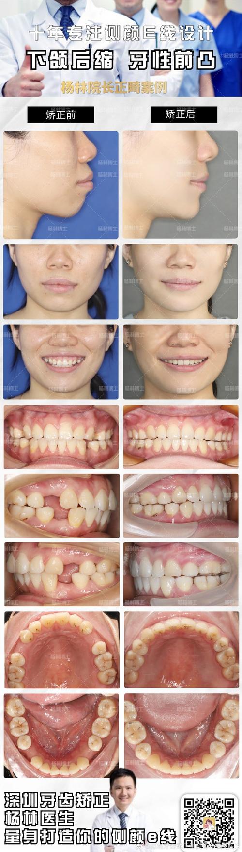 正畸前后侧面对比照-图2