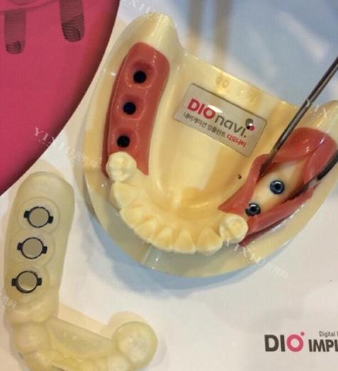 dio植牙-图1 dio植牙-图1