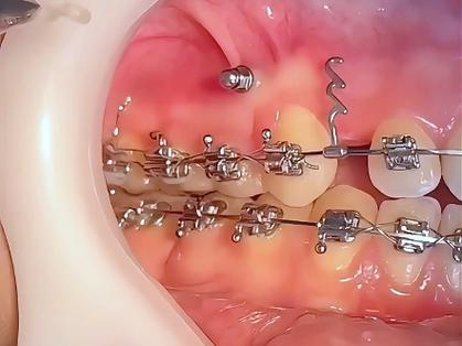 正畸打骨钉内收效果-图1