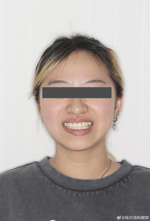 正畸打骨钉内收效果-图3