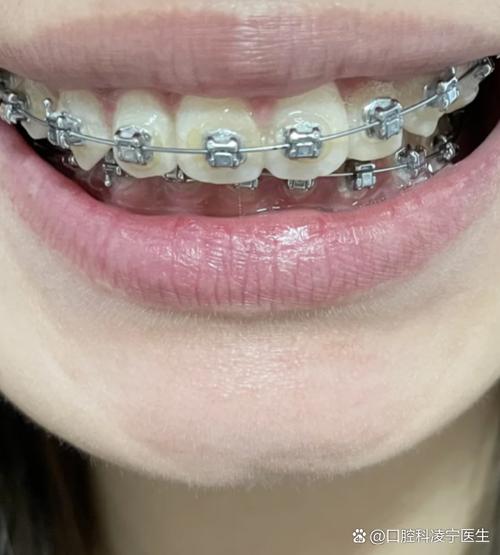 有烤瓷牙能做正畸矫正吗？-图2