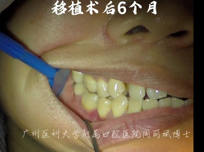 牙槽骨不足必须植骨吗？手术效果如何？-图3