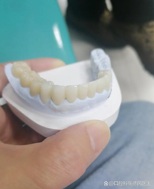 植牙 牙冠-图1 植牙 牙冠-图1