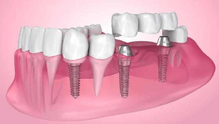 植牙 牙冠-图2 植牙 牙冠-图2