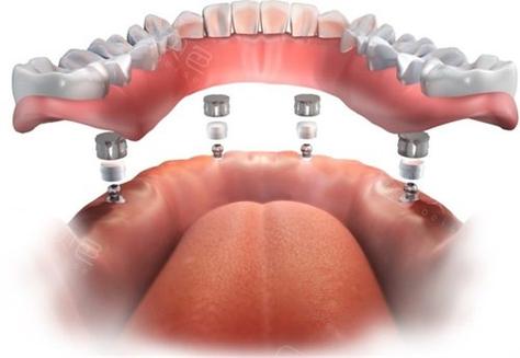 植牙 牙冠-图3 植牙 牙冠-图3