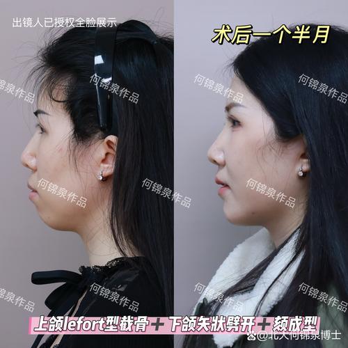 开颌正畸后图片对比-图2