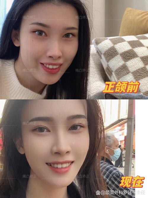 开颌正畸后图片对比-图3