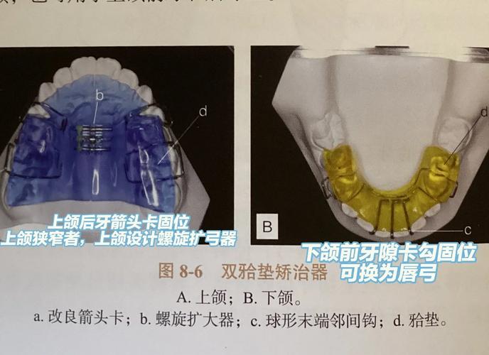 正畸颌垫是干嘛用的-图2