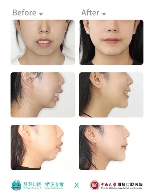 正畸四个月想正颌-图1 正畸四个月想正颌-图1