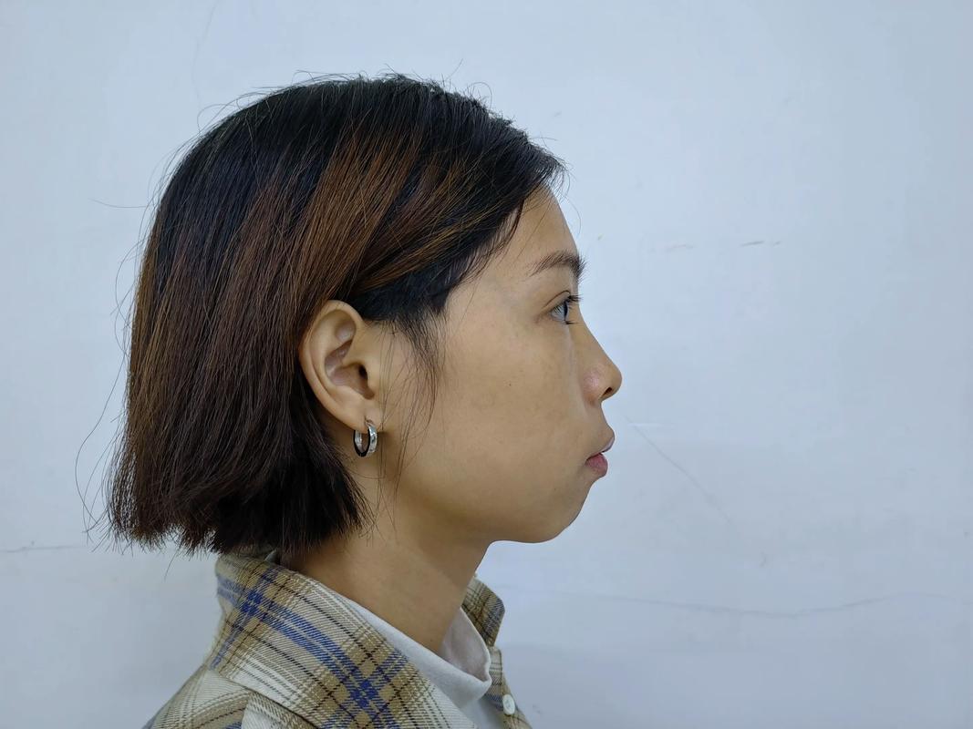 正畸四个月想正颌-图3 正畸四个月想正颌-图3