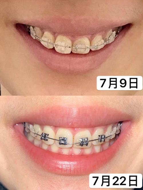 正畸三个月的片子-图1