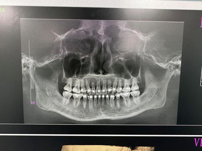 正畸三个月的片子-图2